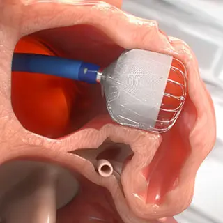 左心耳閉鎖術(LAAC)