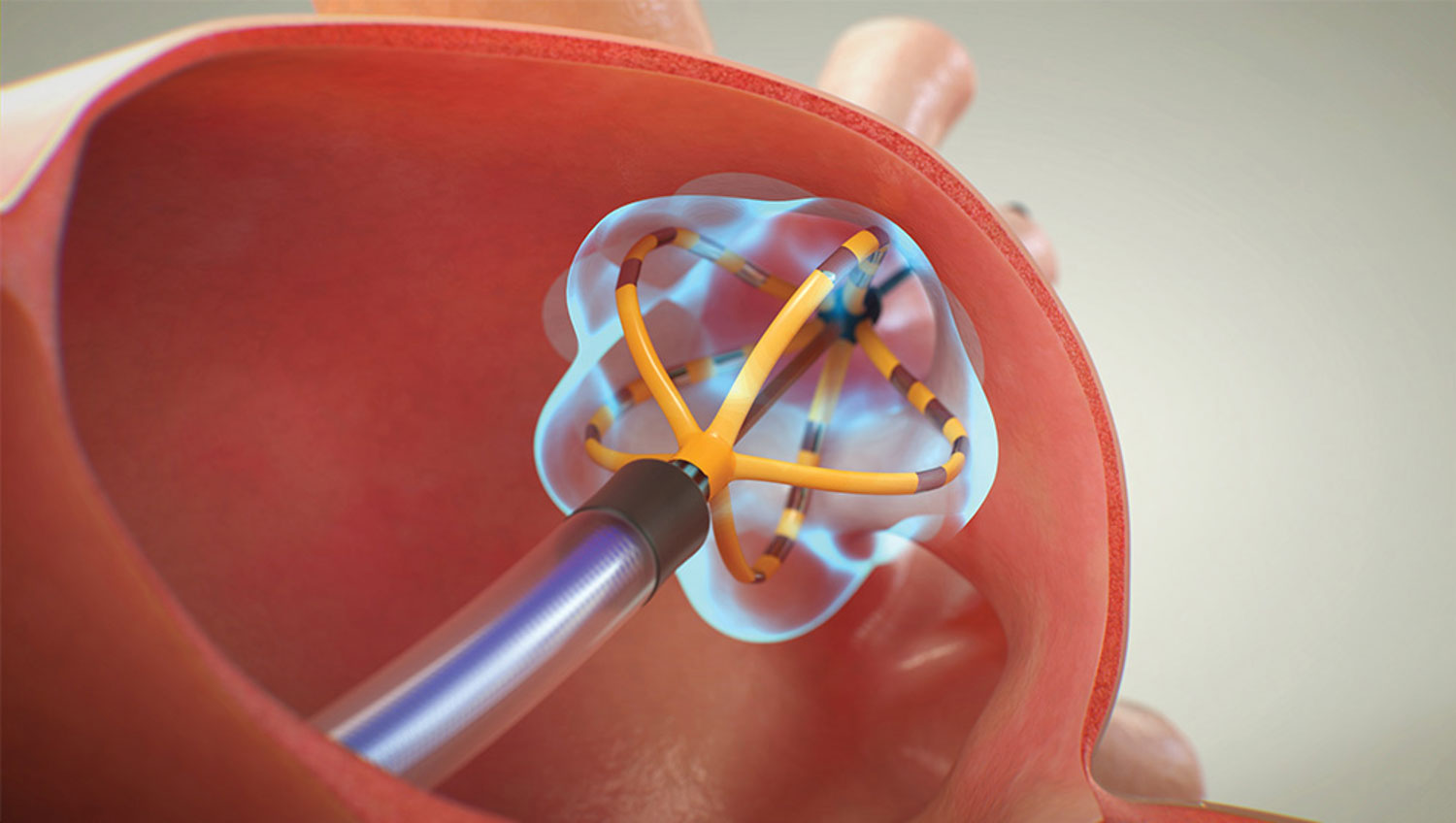 パルスフィールドアブレーション