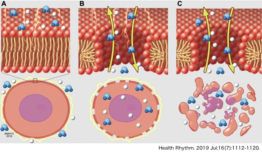 パルスフィールドアブレーションの原理