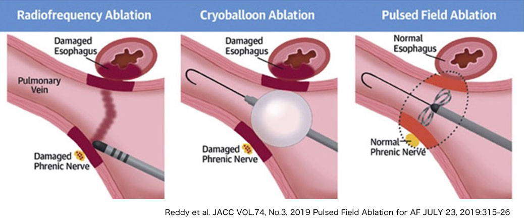 パルスフィールド