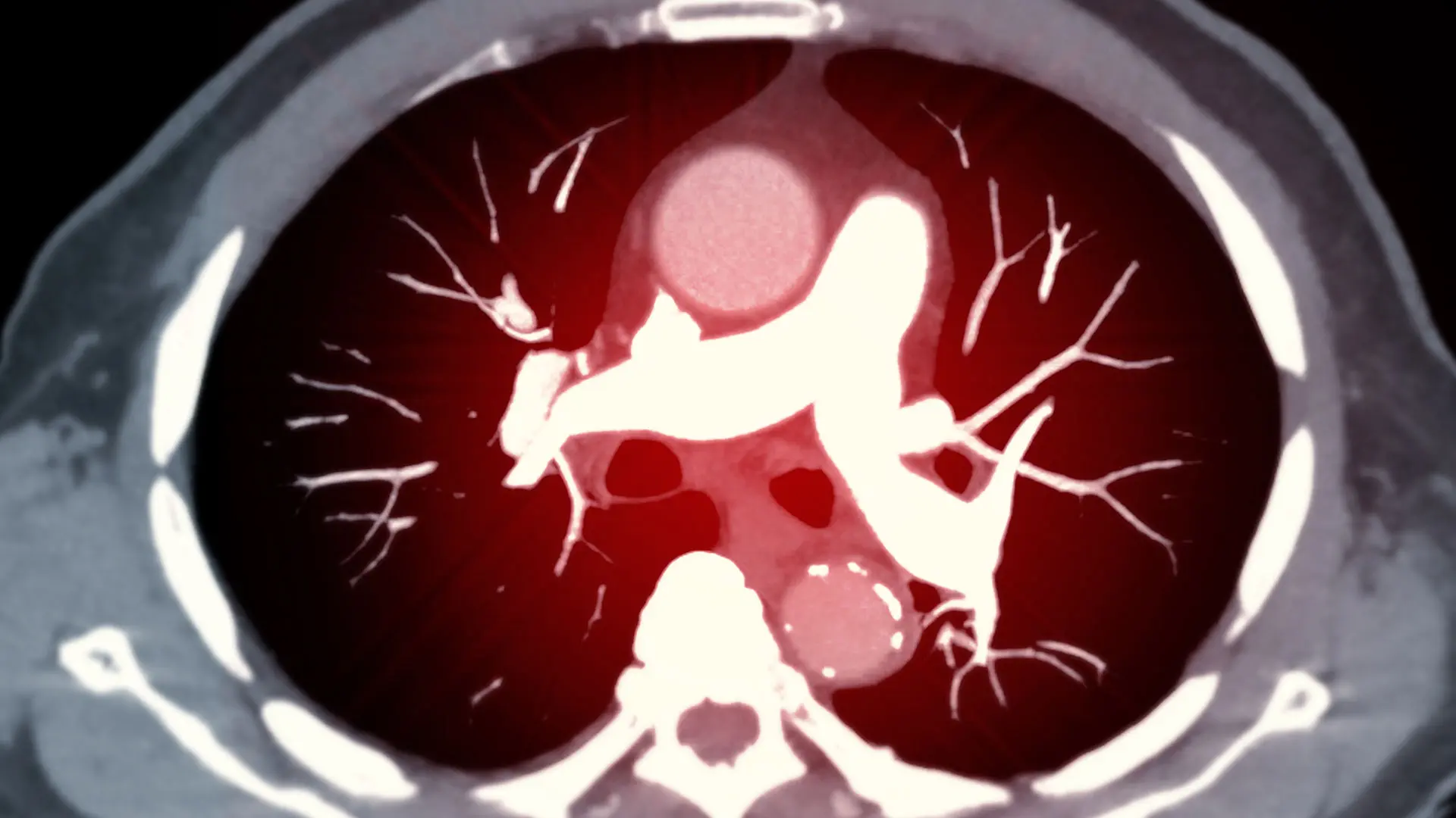 肺塞栓症 Pulmonary Embolism